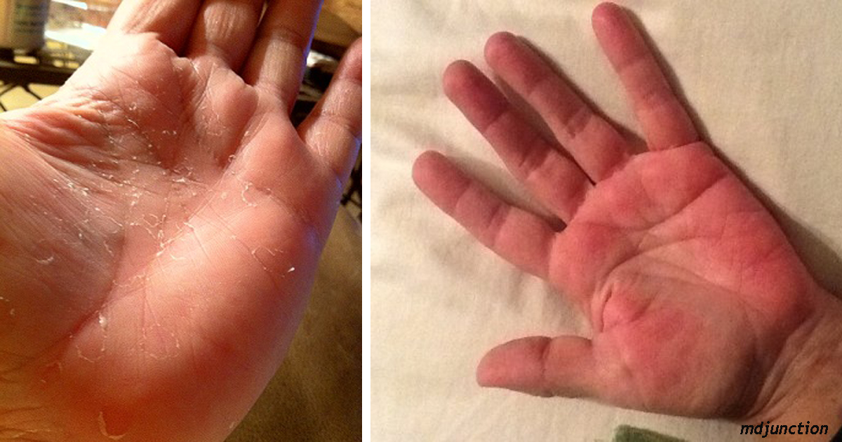 7 опасных болезней, которые можно определить по состоянию рук
