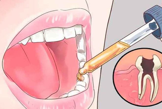 Стоматолог не расскажет: есть 11 домашних способов снять зубную боль